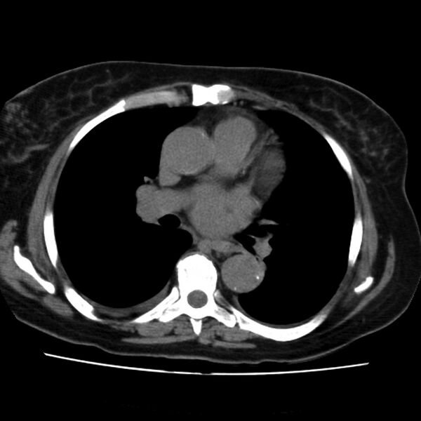 File:Aortic arch pseudoaneurysm (Radiopaedia 8534-9368 Axial non-contrast 38).jpg