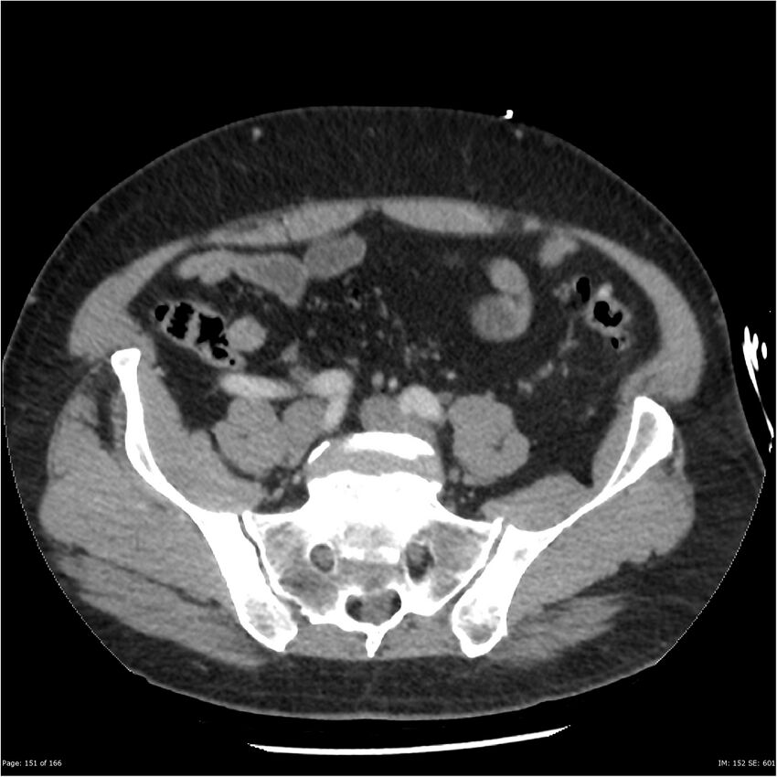 Aortic dissection- Stanford A (Radiopaedia 37759-39664 A 142).jpg