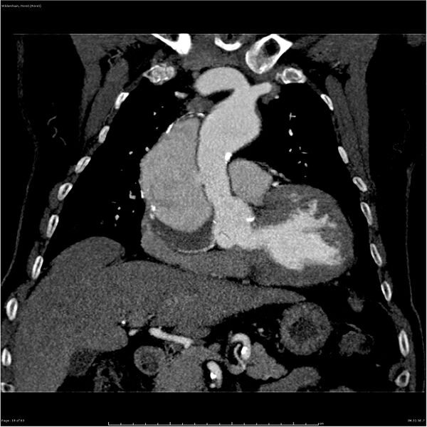 File:Aortic dissection - Stanford type A (Radiopaedia 26183-26315 A 18).jpg