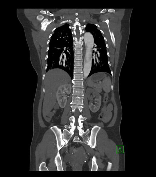 File:Aortic dissection with renal ischemia (Radiopaedia 76573-88338 C 25).jpg