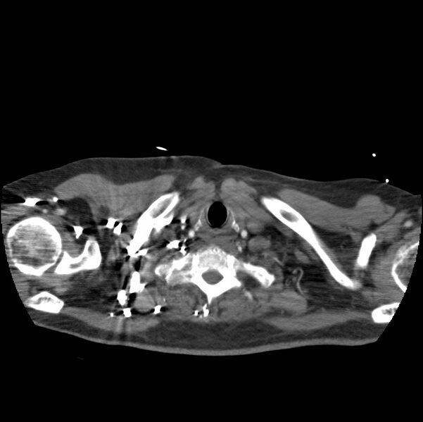 File:Aortic dissection with rupture into pericardium (Radiopaedia 12384-12647 A 4).jpg