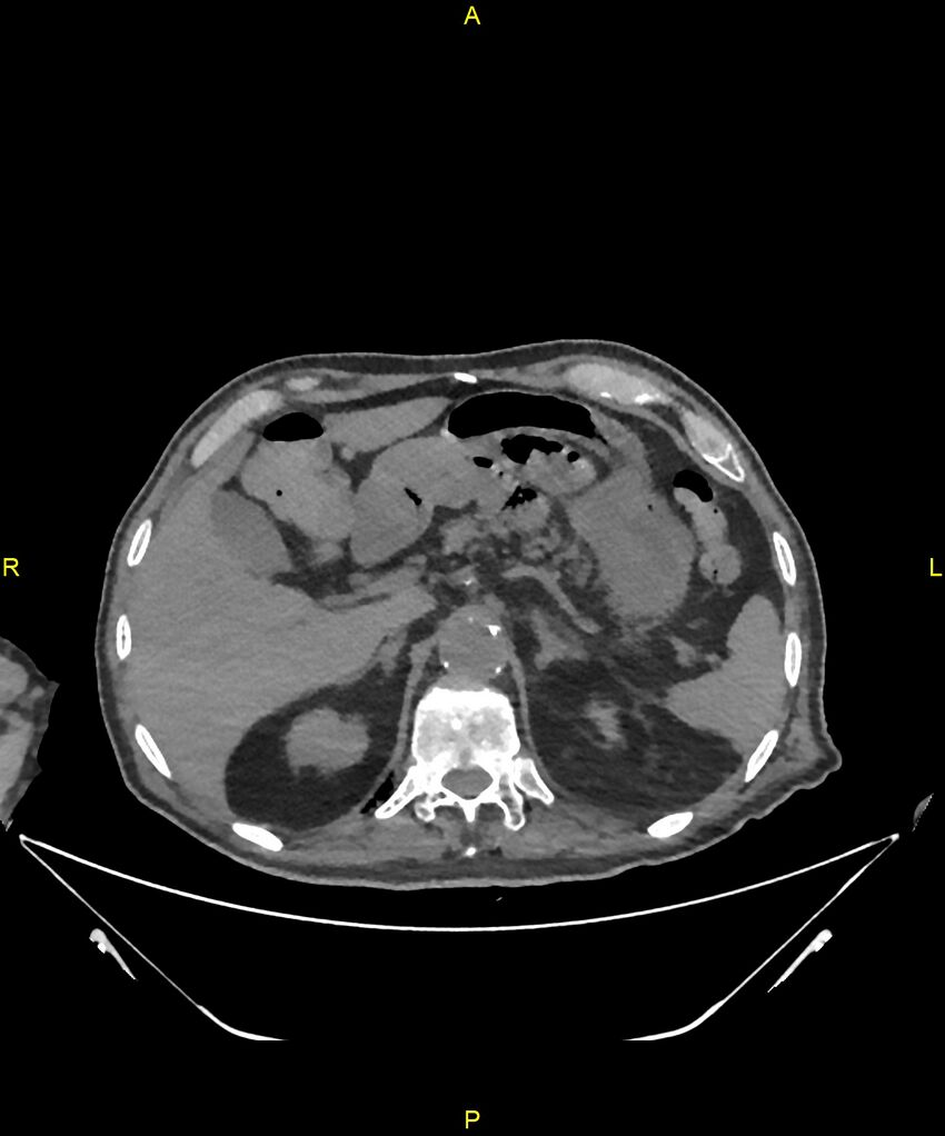 Aortoenteric fistula (Radiopaedia 84308-99603 Axial non-contrast 74).jpg