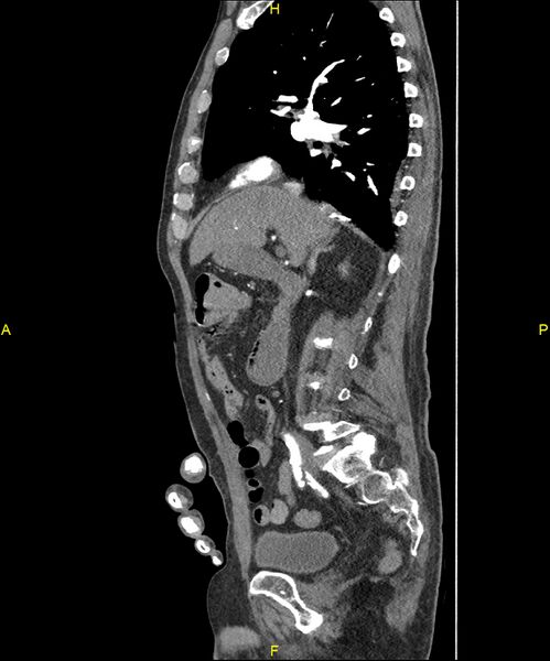 File:Aortoenteric fistula (Radiopaedia 84308-99603 C 138).jpg