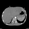 Aortopulmonary window, interrupted aortic arch and large PDA giving the descending aorta (Radiopaedia 35573-37074 B 90).jpg