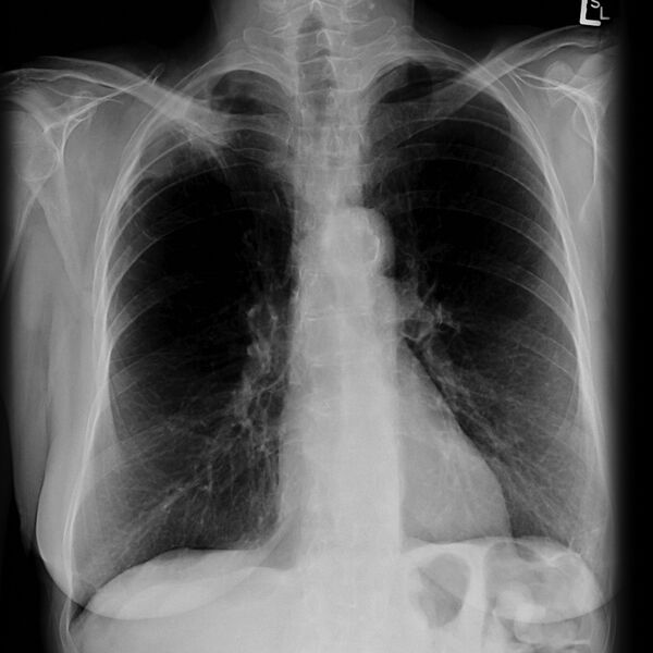 File:Apical non-small-cell lung cancer (Radiopaedia 8570-9404 Frontal 1).jpg