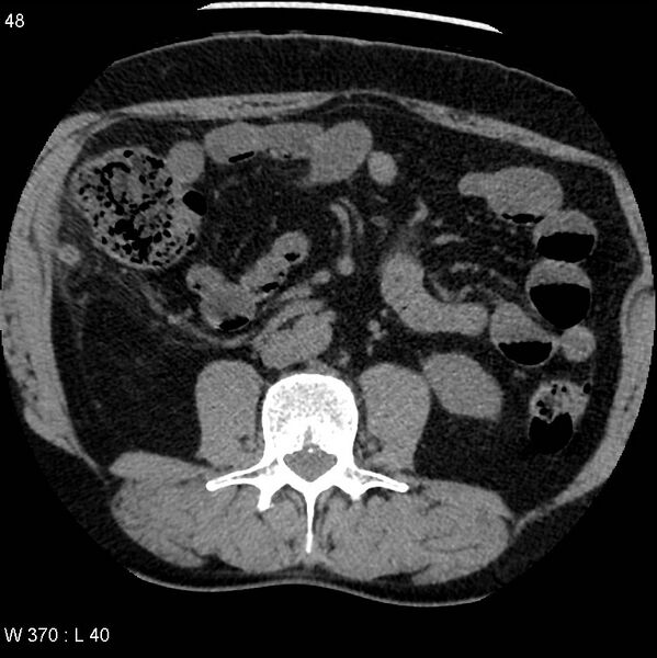File:Appendicitis (Radiopaedia 12510-12733 Axial non-contrast 15).jpg