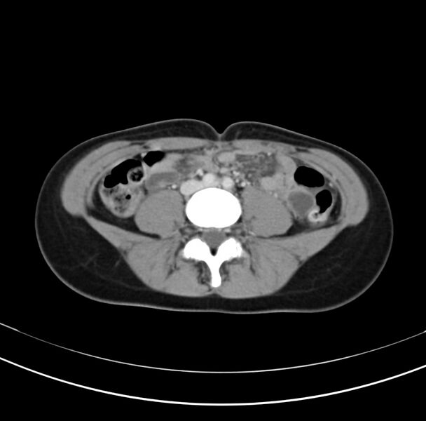 File:Appendicitis and incidental bicornuate uterus (Radiopaedia 22833-22853 B 27).jpg
