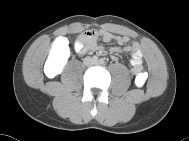 File:Appendicitis and incidental foregut duplication cyst (Radiopaedia 52962-58916 A 42).jpg