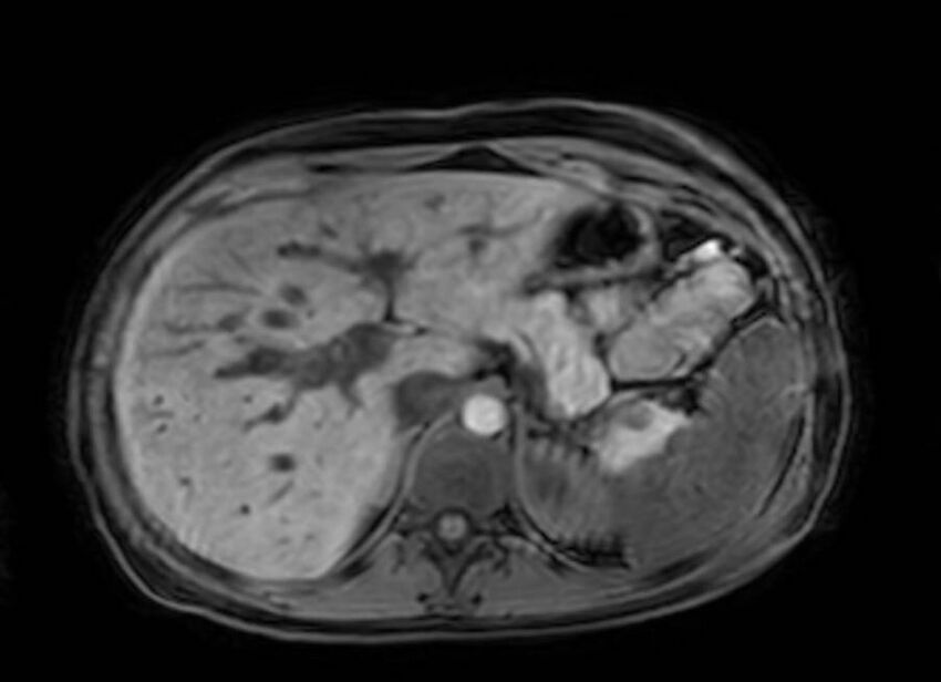 Appendicitis in gravida (MRI) (Radiopaedia 89433-106395 Axial DIXON 25).jpg