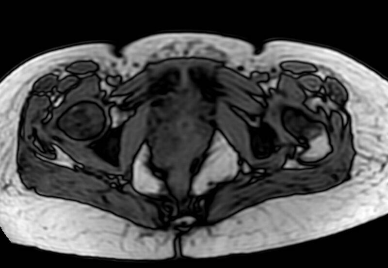 File:Appendicitis in gravida (MRI) (Radiopaedia 89433-106395 D 69).jpg