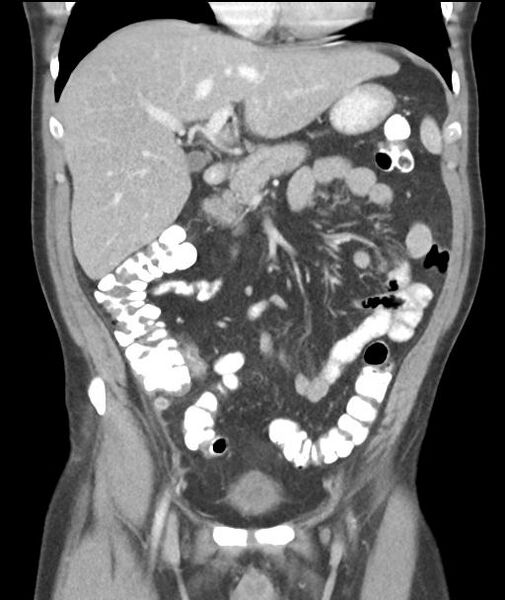 File:Appendicitis with cecal bar sign (Radiopaedia 31878-32830 A 26).jpg