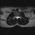 Arachnoid cyst - spinal (Radiopaedia 66835-76157 Axial T2 16).jpg