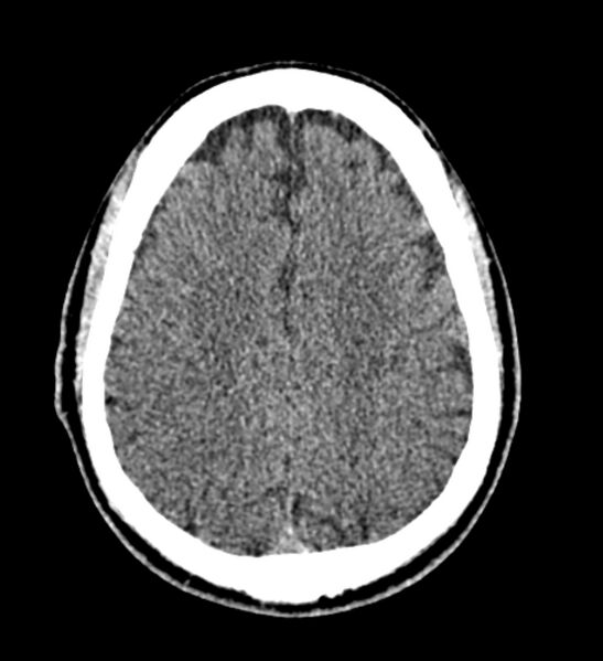 File:Arachnoid cyst of the ambient cistern (Radiopaedia 81301-94986 Axial non-contrast 50).jpg