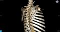 Arrow injury in the neck (Radiopaedia 75268-86390 3D 31).jpg