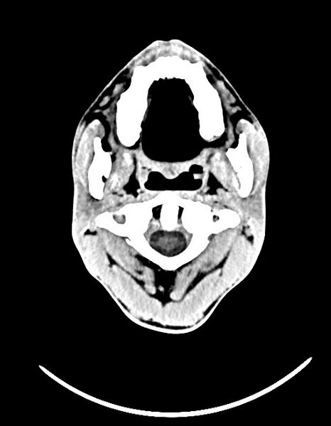 File:Arrow injury to the brain (Radiopaedia 72101-82607 Axial non-contrast 44).jpg