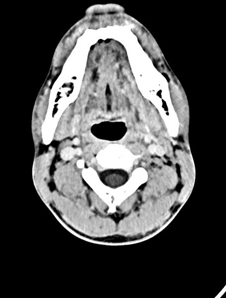 File:Arrow injury to the face (Radiopaedia 73267-84011 Axial C+ delayed 18).jpg