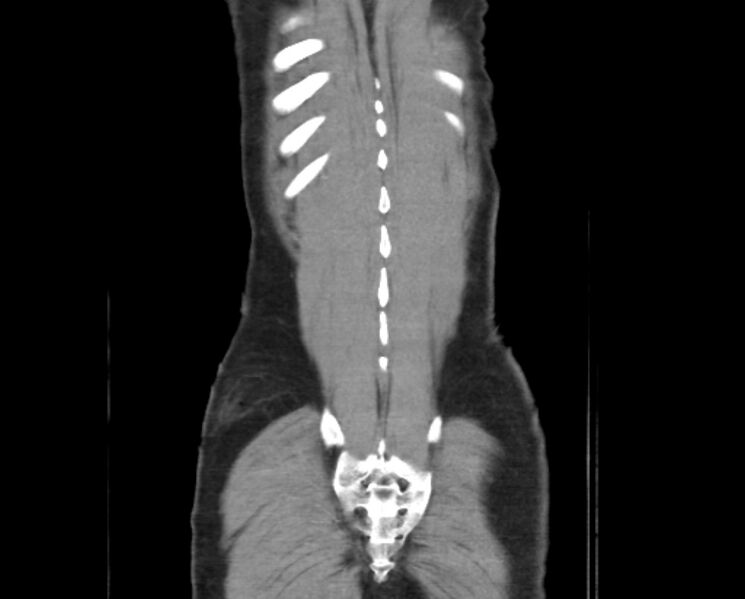 File:Arterial occlusive mesenteric ischemia (Radiopaedia 84641-100060 B 52).jpg