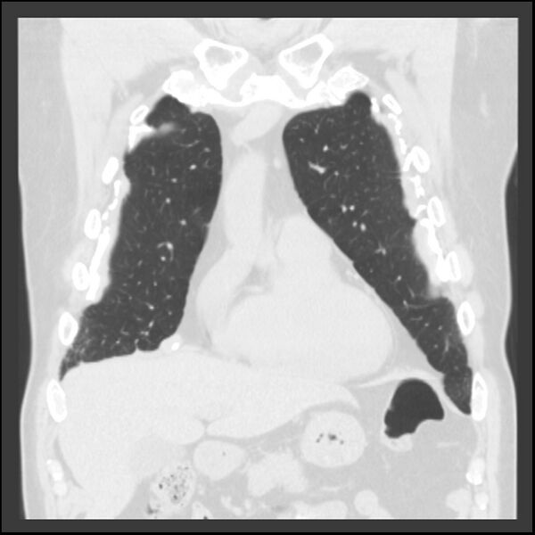 File:Asbestos-related pleural plaques (Radiopaedia 39069-41255 Coronal lung window 67).jpg