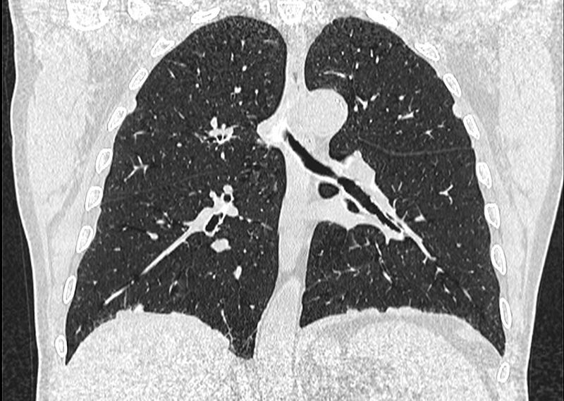 File:Asbestos pleural placques (Radiopaedia 57905-64872 Coronal lung window 172).jpg