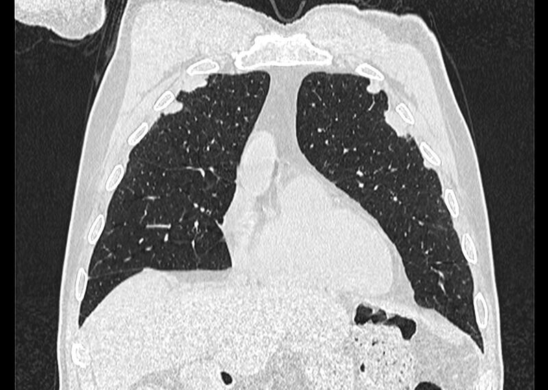 File:Asbestos pleural placques (Radiopaedia 57905-64872 Coronal lung window 67).jpg