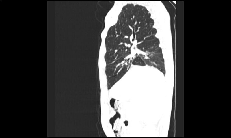 File:Aspergilloma (Radiopaedia 20788-20701 Sagittal lung window 14).jpg