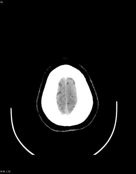 File:Astroblastoma (Radiopaedia 39792-42216 Axial non-contrast 47).jpg