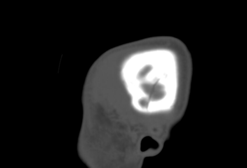 Asymptomatic occipital spur (Radiopaedia 87753-104201 Sagittal bone window 3).jpg