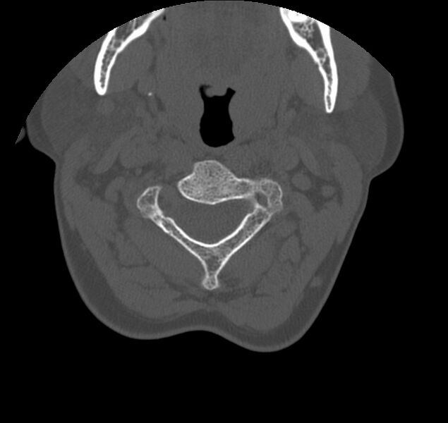 File:Atlanto-occipital assimilation with basilar invagination (Radiopaedia 70122-80188 Axial bone window 44).jpg