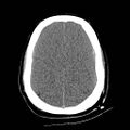 Atlanto-occipital dislocation (Radiopaedia 44648-48412 Axial non-contrast 41).jpg