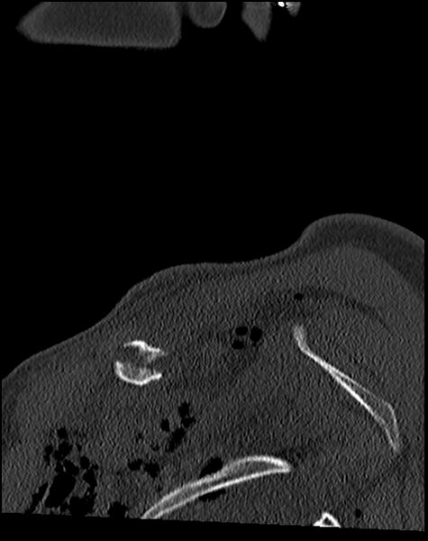 File:Atlanto-occipital dissociation - Traynelis type 1 (Radiopaedia 87570-103948 Sagittal bone window 4).jpg