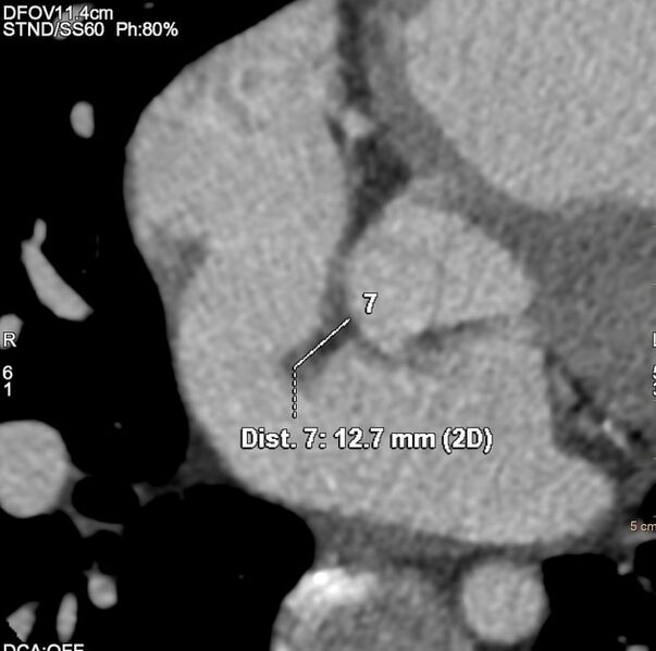 File:Atrial septal defect (upper sinus venosus type) with partial anomalous pulmonary venous return into superior vena cava (Radiopaedia 73228-84051 C+ arterial phase 6).jpeg