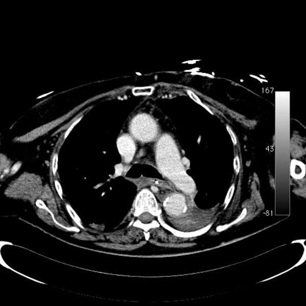 File:Atypical dissection of the thoracic aorta (Radiopaedia 10975-78320 A 23).jpg