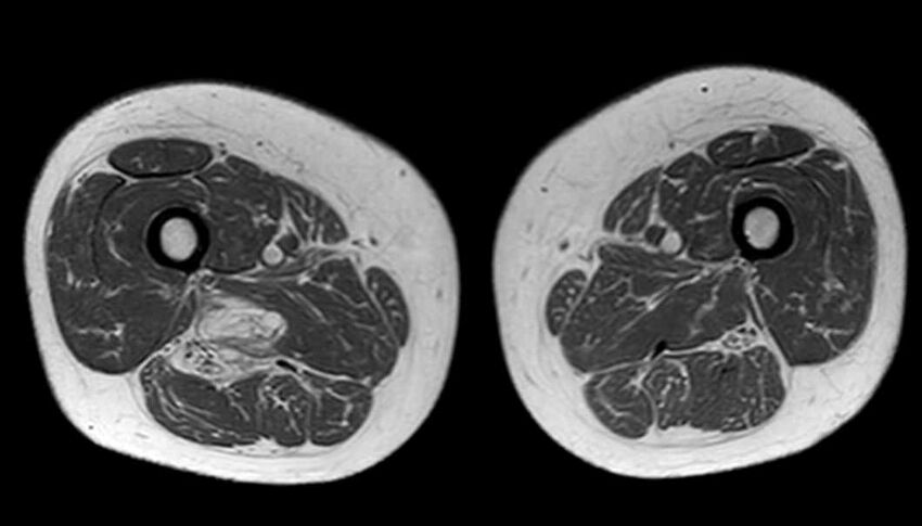Atypical lipomatous tumor - thigh (Radiopaedia 68975-78734 Axial T1 52).jpg