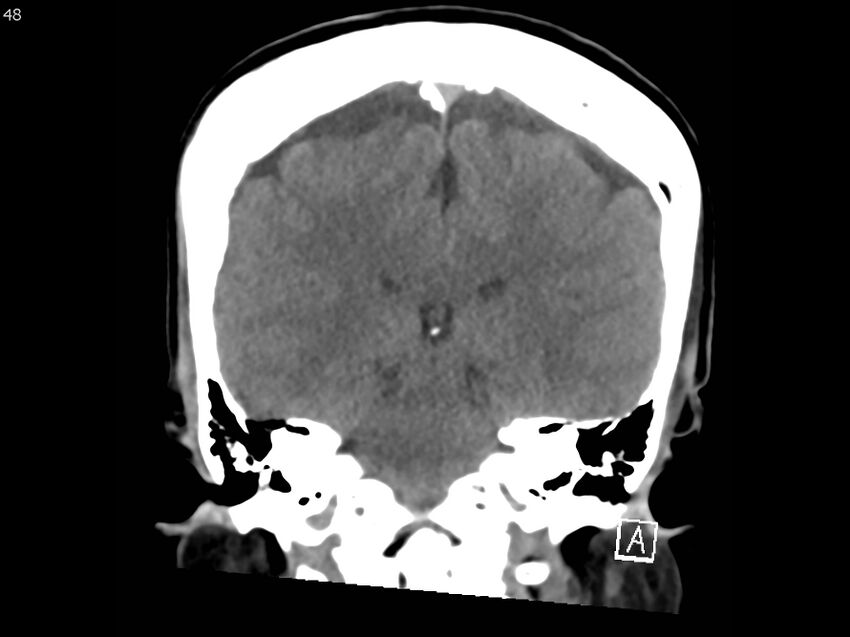 Atypical meningioma - intraosseous (Radiopaedia 64915-73867 B 47).jpg