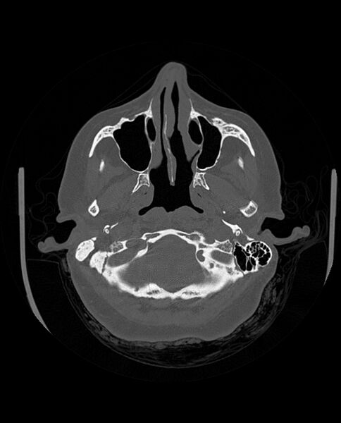 File:Automastoidectomy with labyrinthine fistula (Radiopaedia 84143-99411 Axial non-contrast 61).jpg
