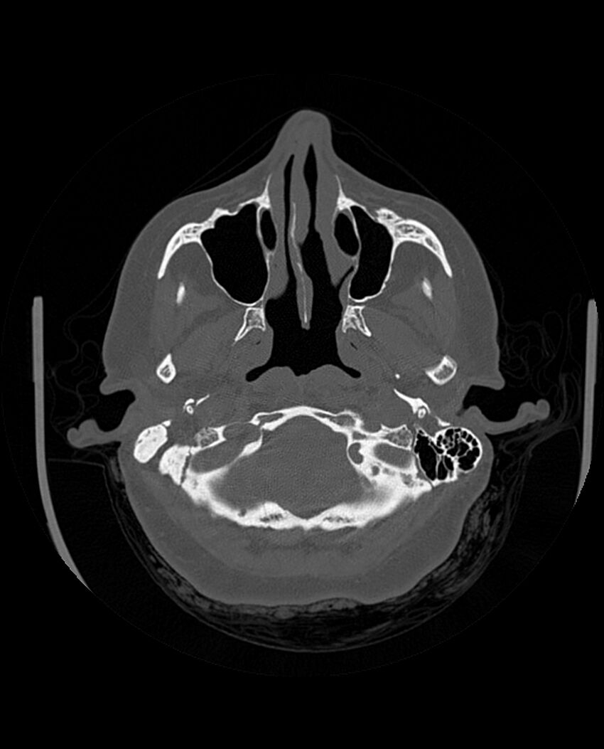 Automastoidectomy with labyrinthine fistula (Radiopaedia 84143-99411 Axial non-contrast 61).jpg