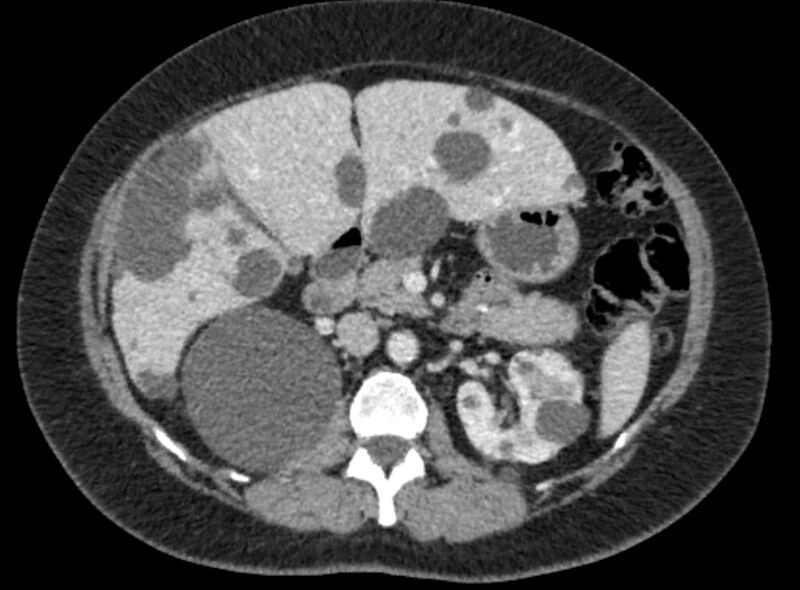 File:Autosomal dominant polycystic kidney disease (Radiopaedia 57124-64017 A 49).jpg