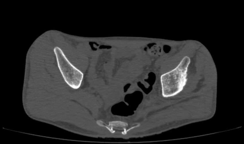 Avascular necrosis of the left hip (Radiopaedia 75068-86125 Axial bone window 7).jpg