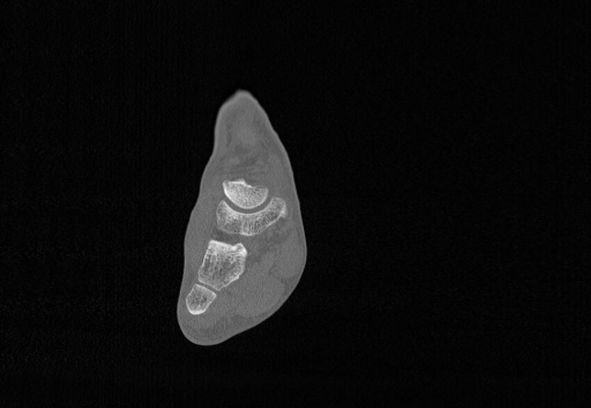 Avulsion fractures of talus and calcaneus (Radiopaedia 48277-53155 Coronal bone window 38).jpg