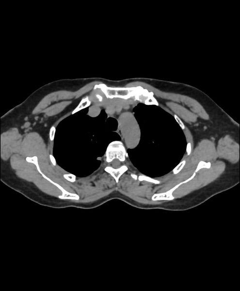 File:Azygos fissure and azygos lobe (Radiopaedia 41841-44832 Axial non-contrast 6).jpg