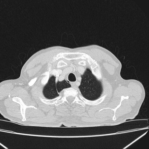 File:Azygos lobe (Radiopaedia 38259-40275 Axial lung window 8).jpg