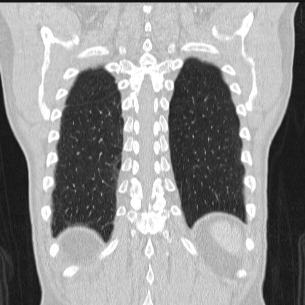File:Azygos lobe (Radiopaedia 38259-40275 Coronal lung window 66).jpg