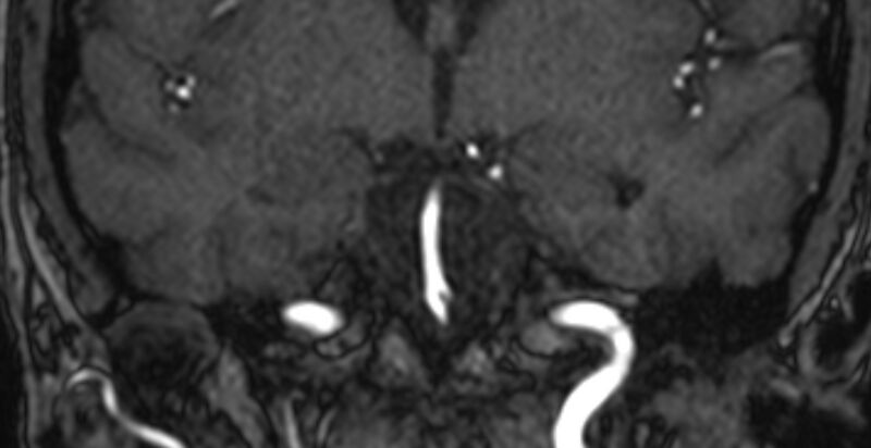 File:Basilar artery fenestration (Radiopaedia 74537-85455 Coronal MRA TOF 36).jpg