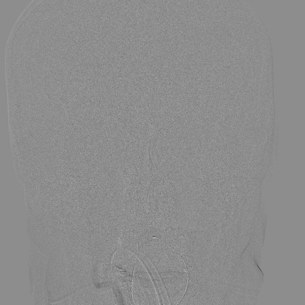 File:Basilar artery occlusion (Radiopaedia 33570-34668 RT VERT IC 8).png