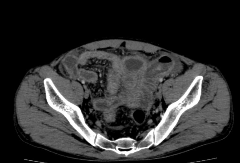 File:Behçet's disease- abdominal vasculitis (Radiopaedia 55955-62570 A 75).jpg