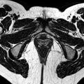 Bicornuate uterus (Radiopaedia 11104-11492 Axial T2 2).jpg