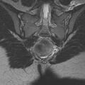 Bicornuate uterus (Radiopaedia 24677-24949 Coronal T2 23).jpg