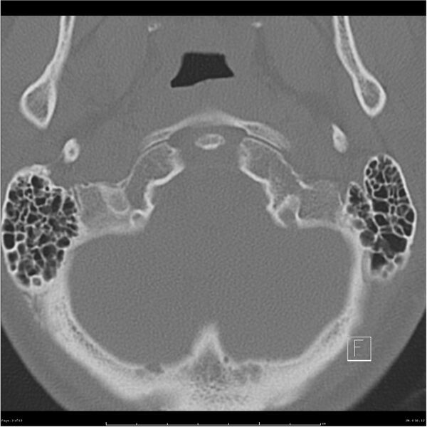 File:Bilateral cervical ribs (Radiopaedia 25868-26017 Axial bone window 3).jpg