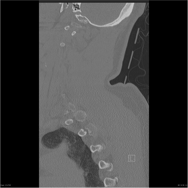 File:Bilateral cervical ribs (Radiopaedia 25868-26017 Sagittal bone window 13).jpg