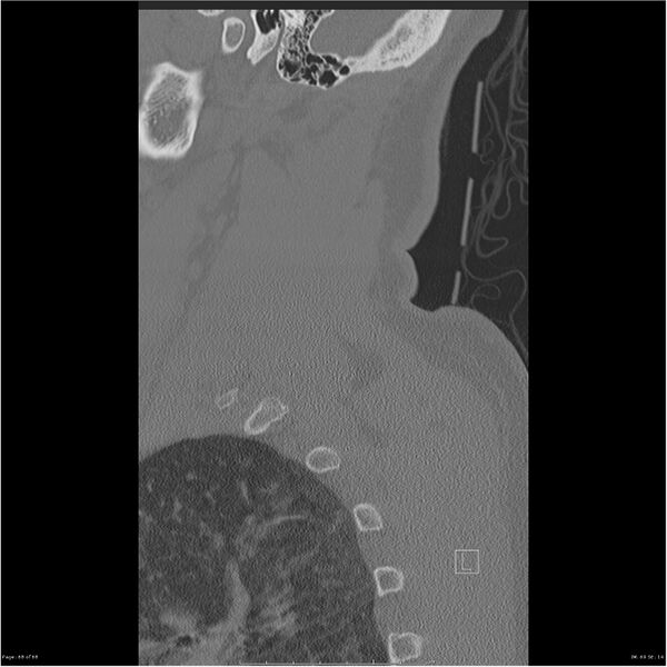 File:Bilateral cervical ribs (Radiopaedia 25868-26017 Sagittal bone window 68).jpg